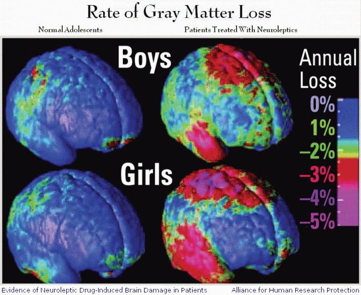 average rate of gray matter loss in normal adolescents vs. patients treated with psychotropic medication